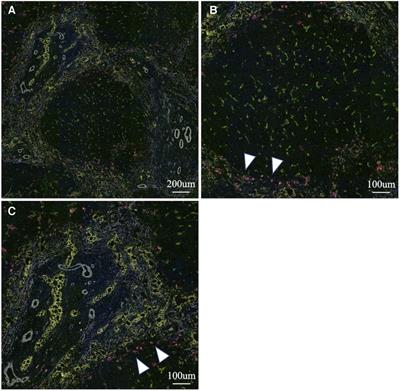 The clinical impact of macrophage polarity after Kasai portoenterostomy in biliary atresia